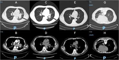 Accurate diagnosis of bronchopulmonary Talaromyces marneffei infection in an anti-IFN-γ autoantibodies positive patient assisted by endobronchial ultrasound-guided TBNA and mNGS: a case report